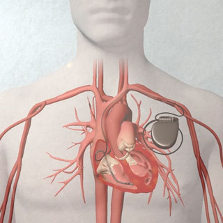 What is a pacemaker?